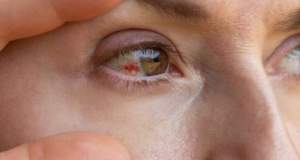 دلایل پارگی رگ خونی در چشم؛ چه موقع باید به پزشک مراجعه کنیم؟
